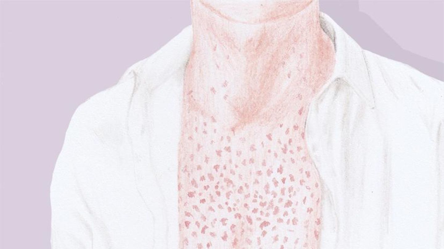 Illustration von Oberkörper mit Hautausschlag