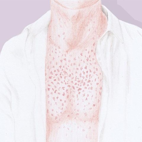 Illustration von Oberkörper mit Hautausschlag