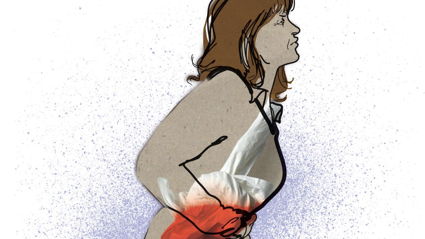 Illustration Darmendometriose