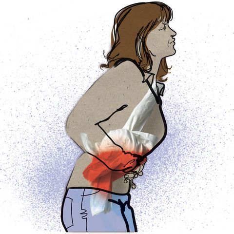 Illustration Darmendometriose