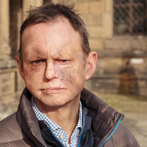Arzt und Krebspatient: Wolfram Gössling litt an einem Angiosarkom, einem seltenen Tumor des Bindegewebes. Er musste mehrfach im Gesicht operiert werden