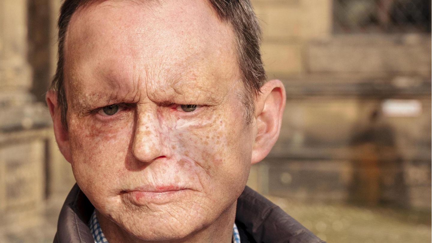 Wolfram Gössling: Arzt und Krebspatient: Wolfram Gössling litt an einem Angiosarkom, einem seltenen Tumor des Bindegewebes. Er musste mehrfach im Gesicht operiert werden Arzt und Krebspatient: Wolfram Gössling litt an einem Angiosarkom, einem seltenen Tumor des Bindegewebes. Er musste mehrfach im Gesicht operiert werden