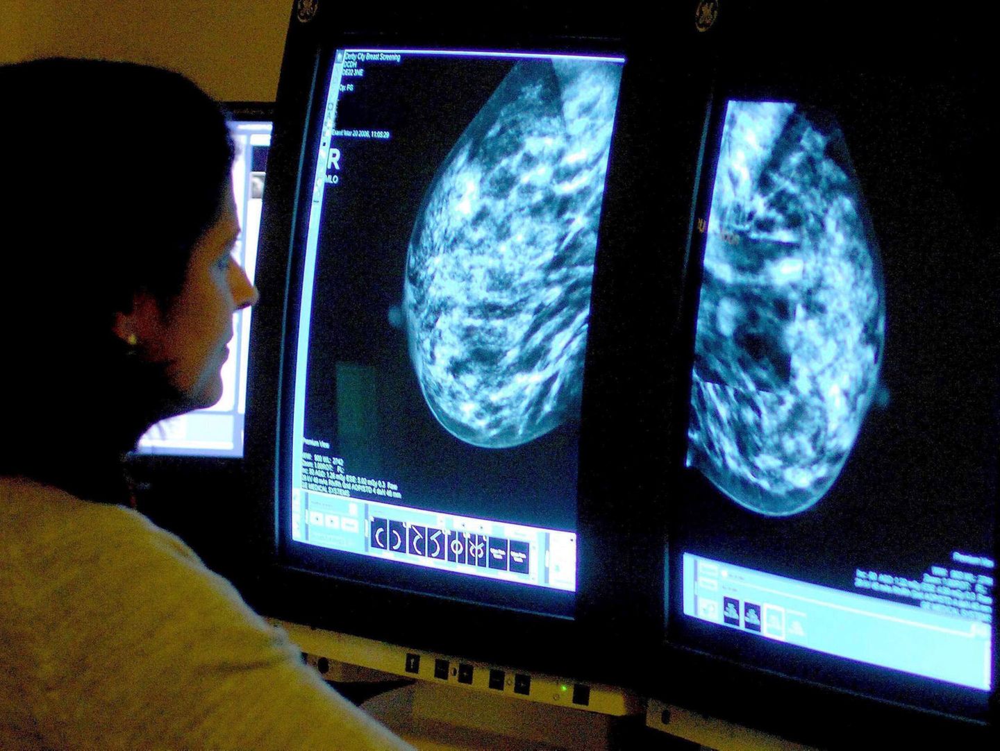 Früherkennung von Brustkrebs In den USA soll Brustkrebs jetzt durch die Früherkennung mit der Mammografie rechtzeitig erkannt und behandelt werden können