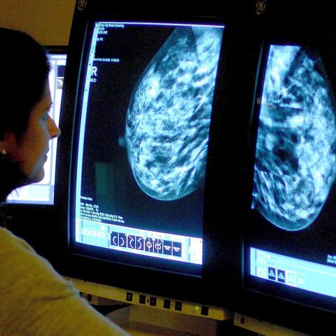 In den USA soll Brustkrebs jetzt durch die Früherkennung mit   der Mammografie rechtzeitig erkannt und behandelt werden können
