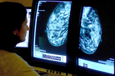 In den USA soll Brustkrebs jetzt durch die Früherkennung mit   der Mammografie rechtzeitig erkannt und behandelt werden können