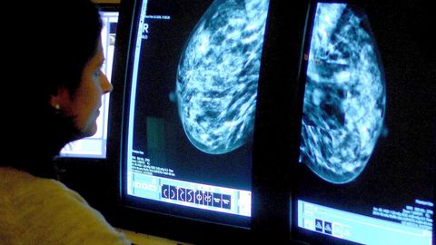 In den USA soll Brustkrebs jetzt durch die Früherkennung mit   der Mammografie rechtzeitig erkannt und behandelt werden können