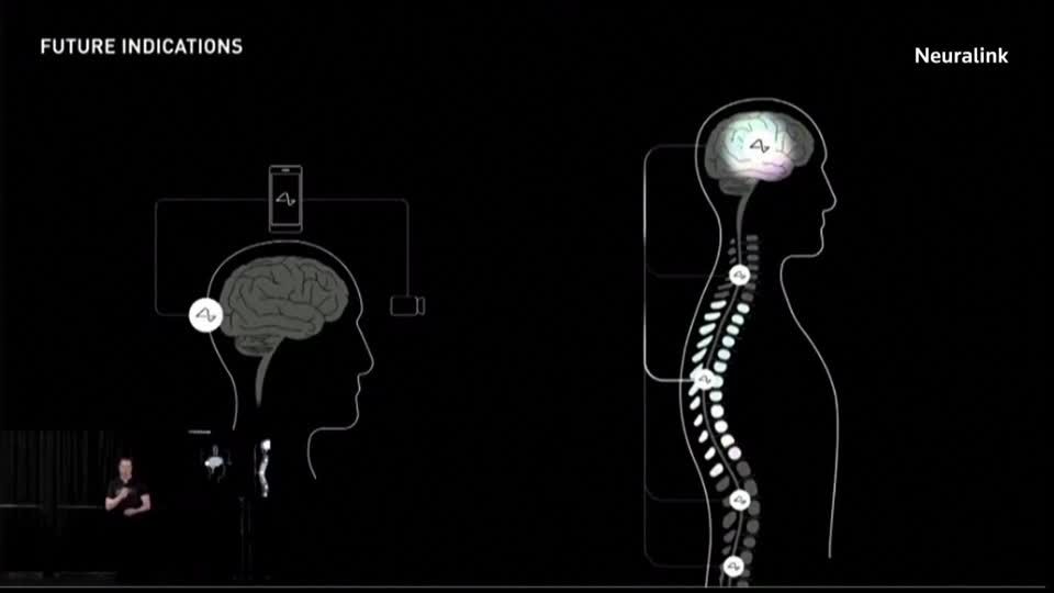 Video: Neuralink verkündet Zulassung für Studie am Menschen