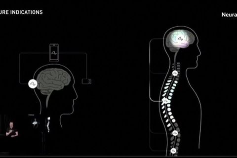 Video: Neuralink verkündet Zulassung für Studie am Menschen