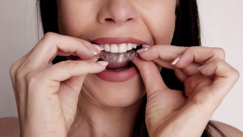 Behandlung mit Alignern: Eine Frau setzt eine durchsichtige Zahnschiene ein