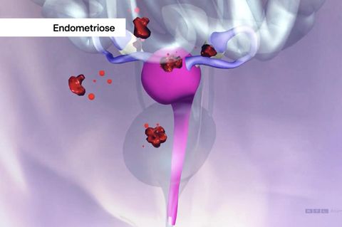 Endometriose-Forschung: Mediziner können schmerzhafte Unterleibserkrankung in Zukunft gezielter behandeln