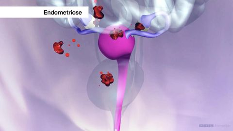 Endometriose-Forschung: Mediziner können schmerzhafte Unterleibserkrankung in Zukunft gezielter behandeln