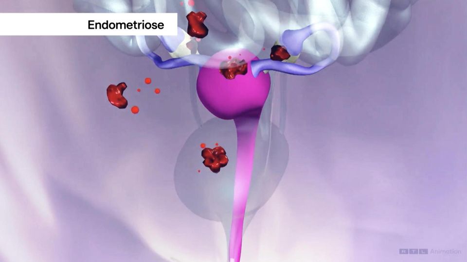 Endometriose-Forschung: Mediziner können schmerzhafte Unterleibserkrankung in Zukunft gezielter behandeln