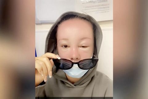 Orla McGlynn erleidet Sonnenvergiftung und bekommt ihre Augen kaum noch auf