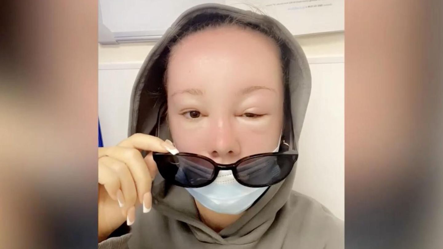 Woman suffers sun poisoning and can hardly open her eyes