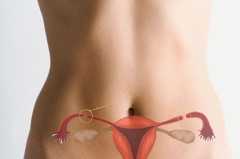 Sterilisation bei Frauen