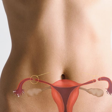 Sterilisation bei Frauen