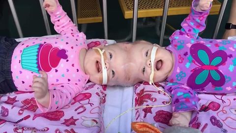 Kaum Überlebenschance: Siamesische Zwillinge haben den Kindergarten geschafft
