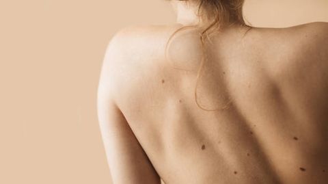 Hautkrebs: Das Bild zeigt den Rücken einer Frau mit Muttermalen
