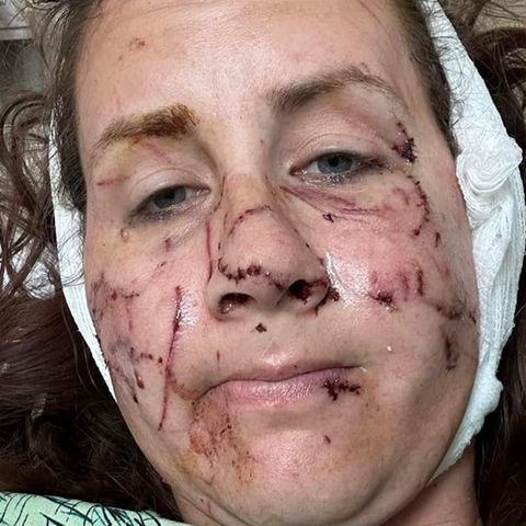 Gesicht und Körper von Jen Royce aus den USA sind nach dem Otter-Angriff von zahlreichen Wunden übersäht