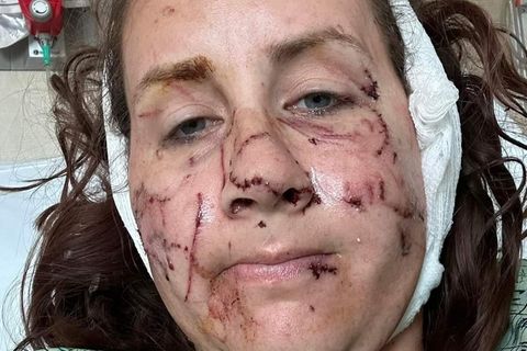 Gesicht und Körper von Jen Royce aus den USA sind nach dem Otter-Angriff von zahlreichen Wunden übersäht