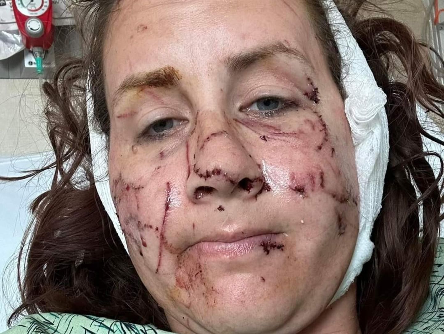 Gesicht und Körper von Jen Royce aus den USA sind nach dem Otter-Angriff von zahlreichen Wunden übersäht