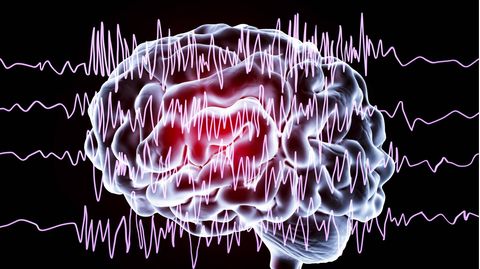 Computerillustration eines Gehirns und Gehirnwellen bei Epilepsie