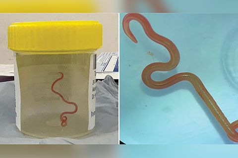 Ungebetener Gast: Das Bild zeigt den lebenden Spulwurm "Ophidascaris robertsi", der im Gehirn einer 64-jährigen Australierin gefunden wurde.