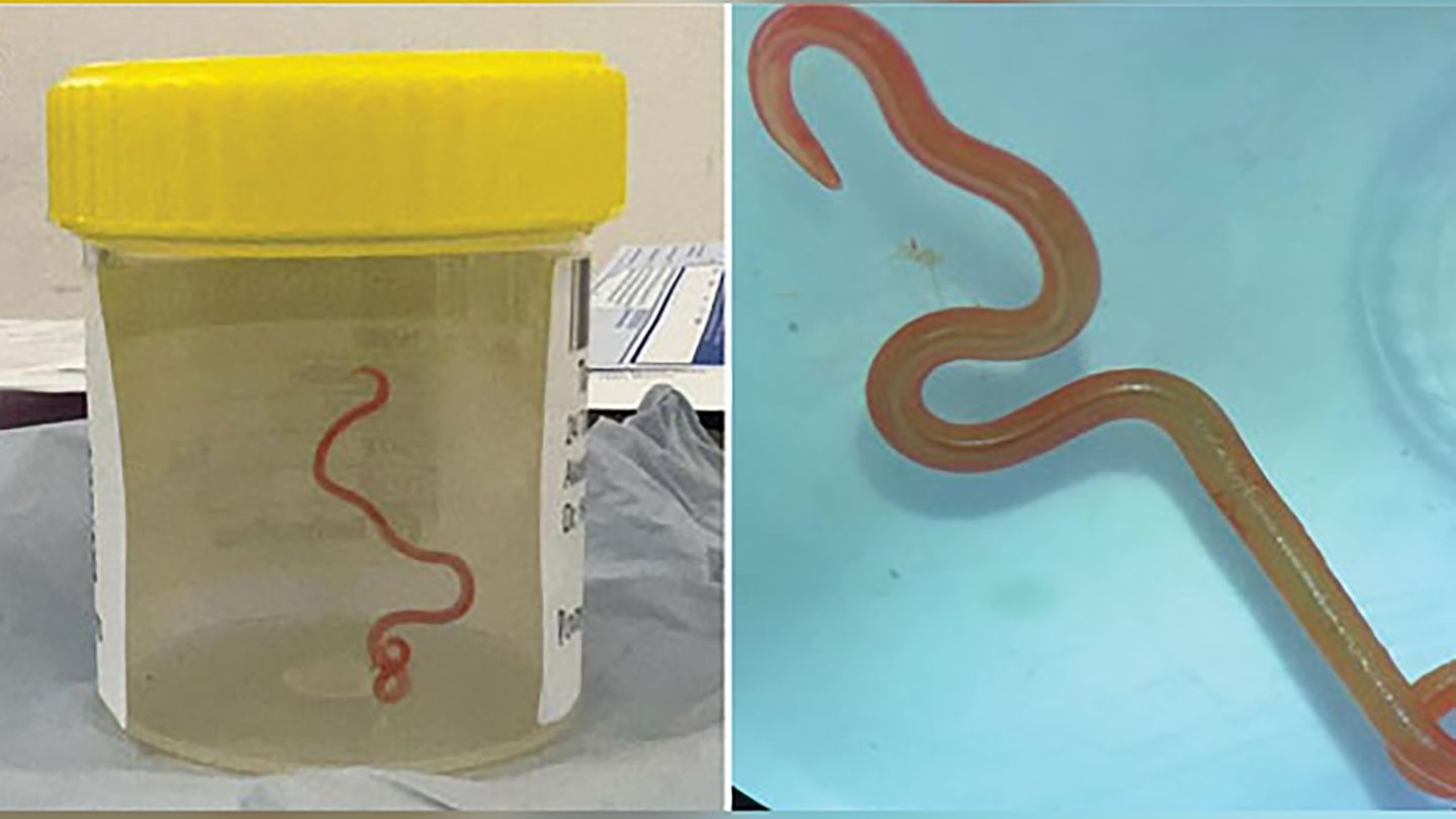 Ungebetener Gast: Das Bild zeigt den lebenden Spulwurm "Ophidascaris robertsi", der im Gehirn einer 64-jährigen Australierin gefunden wurde.