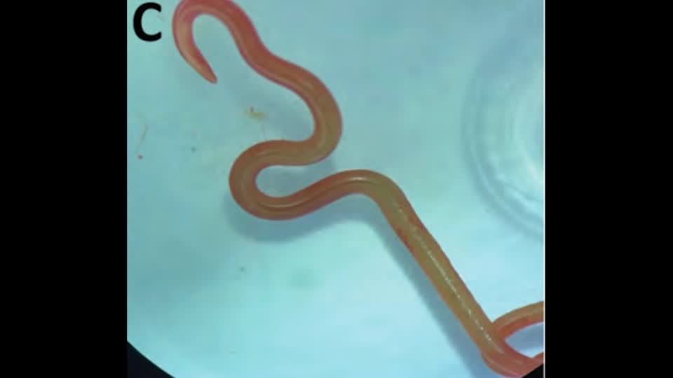 Video: Australien: Lebendiger Wurm im Gehirn einer Patientin entdeckt