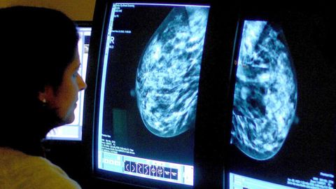 Eine Frau analysiert die Bilder einer Mammographie auf einem Monitor
