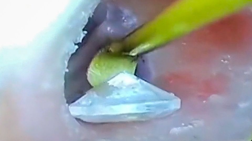 Unerwarteter Fund: Kleines Vermögen im Ohr – Arzt fischt Frau einen Diamanten aus dem Gehörgang