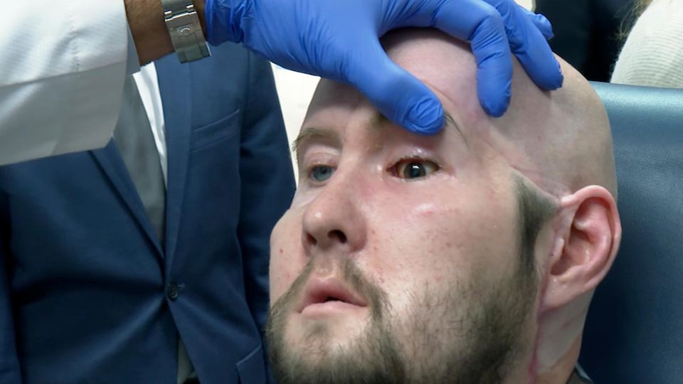 Patient Aaron James: Erstmals komplettes Auge transplantiert
