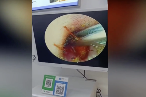 Ein Mann aus dem chinesischen Shanghai ließ sich wegen Ohrenschmerzen untersuchen. Sein Arzt machte währenddessen eine unerwartete Entdeckung im Gehörgang des Patienten.     