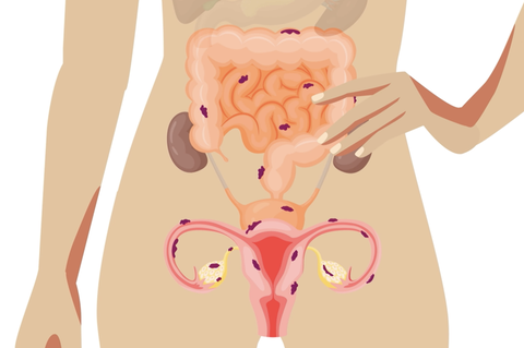 Was ist eigentlich Endometriose?