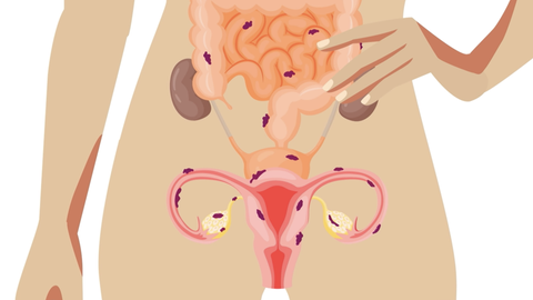 Was ist eigentlich Endometriose?