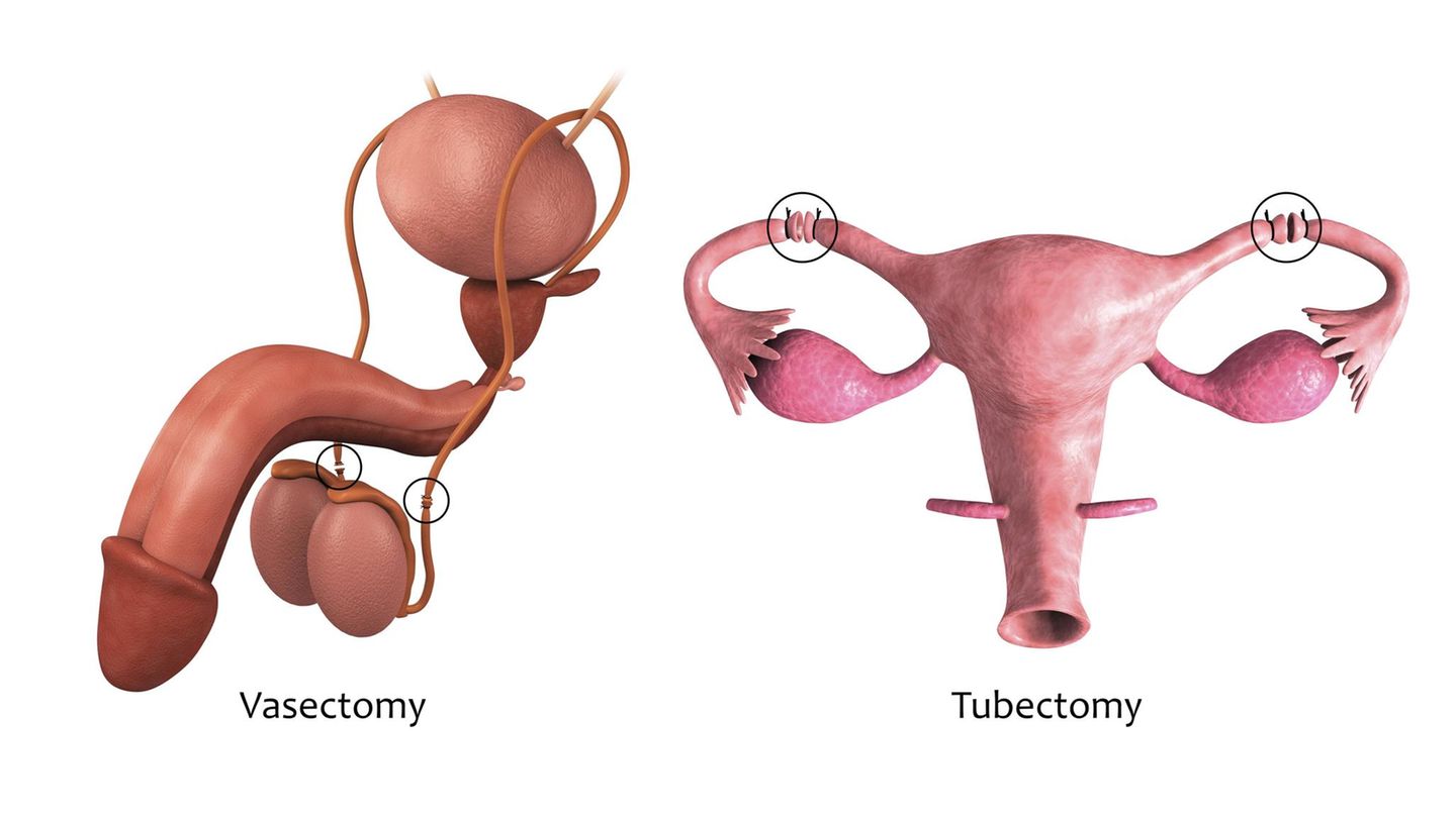 Abbildung Vasektomie und Tubetomy Abbildung Vasektomie und Tubetomy