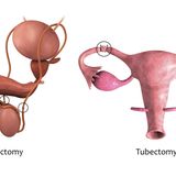 Abbildung Vasektomie und Tubetomy