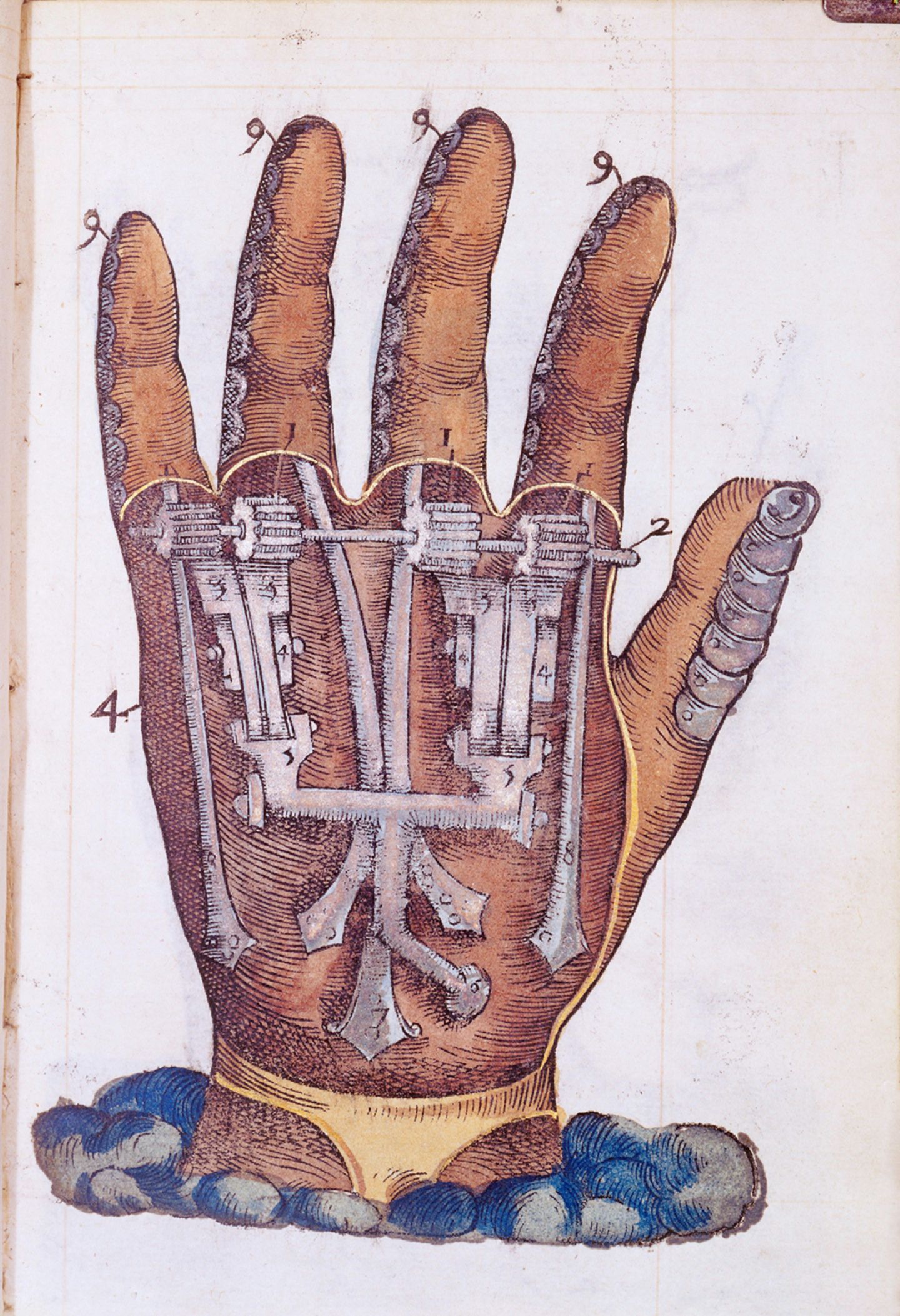 Handprothese von Paré