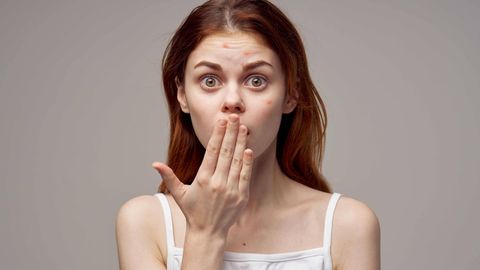 Stiftung Warentest: Bloß nicht ausdrücken! Was wirklich gegen Akne-Pickel hilft – sechs Tipps