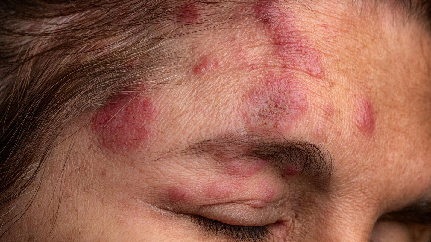 Gürtelrose Herpes Zoster im Gesicht