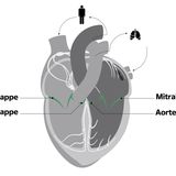 Infografik Herzklappen
