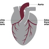 Infografik Kranzgefäße im menschlichen Herzen: Aorta, rechte und linke Koronarterie