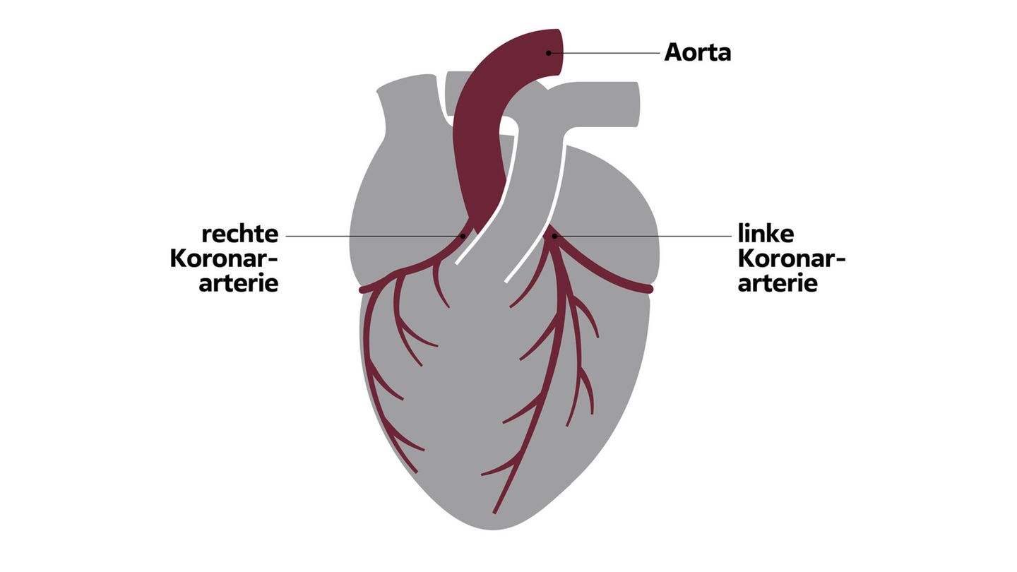 Infografik Kranzgefäße im menschlichen Herzen: Aorta, rechte und linke Koronarterie