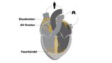 Infografik des Erregungsleitungssystems im menschlichen Herzen: Sinusknoten, AV-Knoten und Faserbündel im Herzen