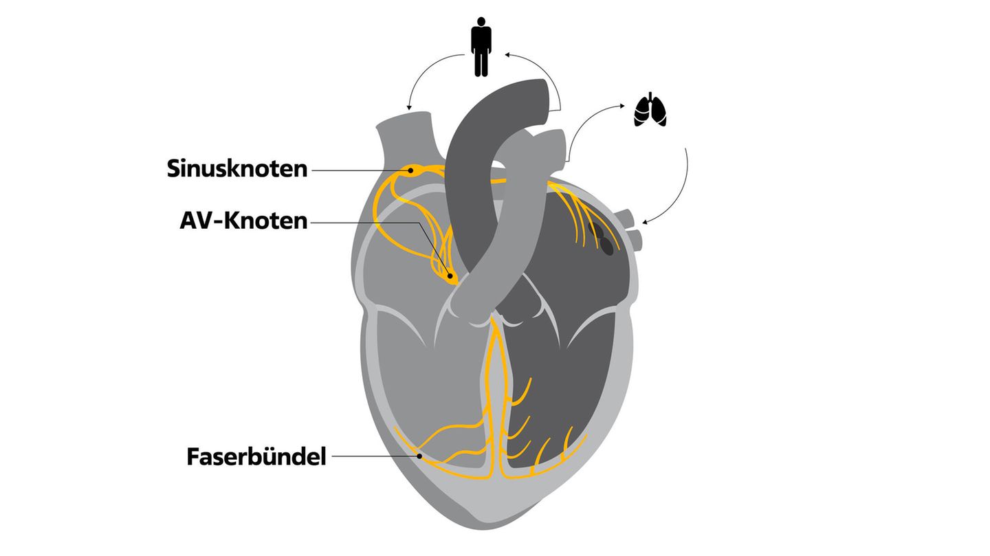 Infografik des Erregungsleitungssystems im menschlichen Herzen: Sinusknoten, AV-Knoten und Faserbündel im Herzen