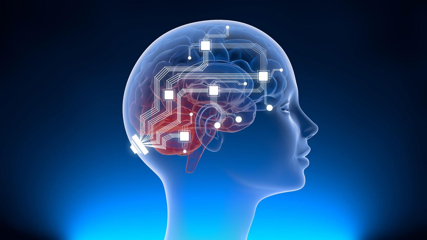 Neuralink implantiert Computerkomponenten chirurgisch auf die Oberfläche des Gehirns, um Geräte zu steuern (Symbolbild)