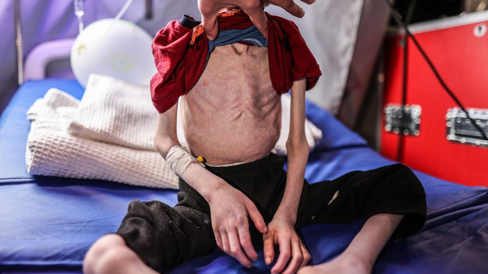 Een unterernährtes Kind in Gaza ligt bij een Krankenhausbett.  Die Rippen sind deutlich zu sehen