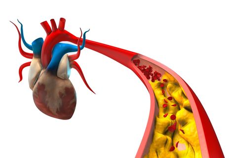 Illustration einer Aorta mit Cholesterin-Ablagerungen