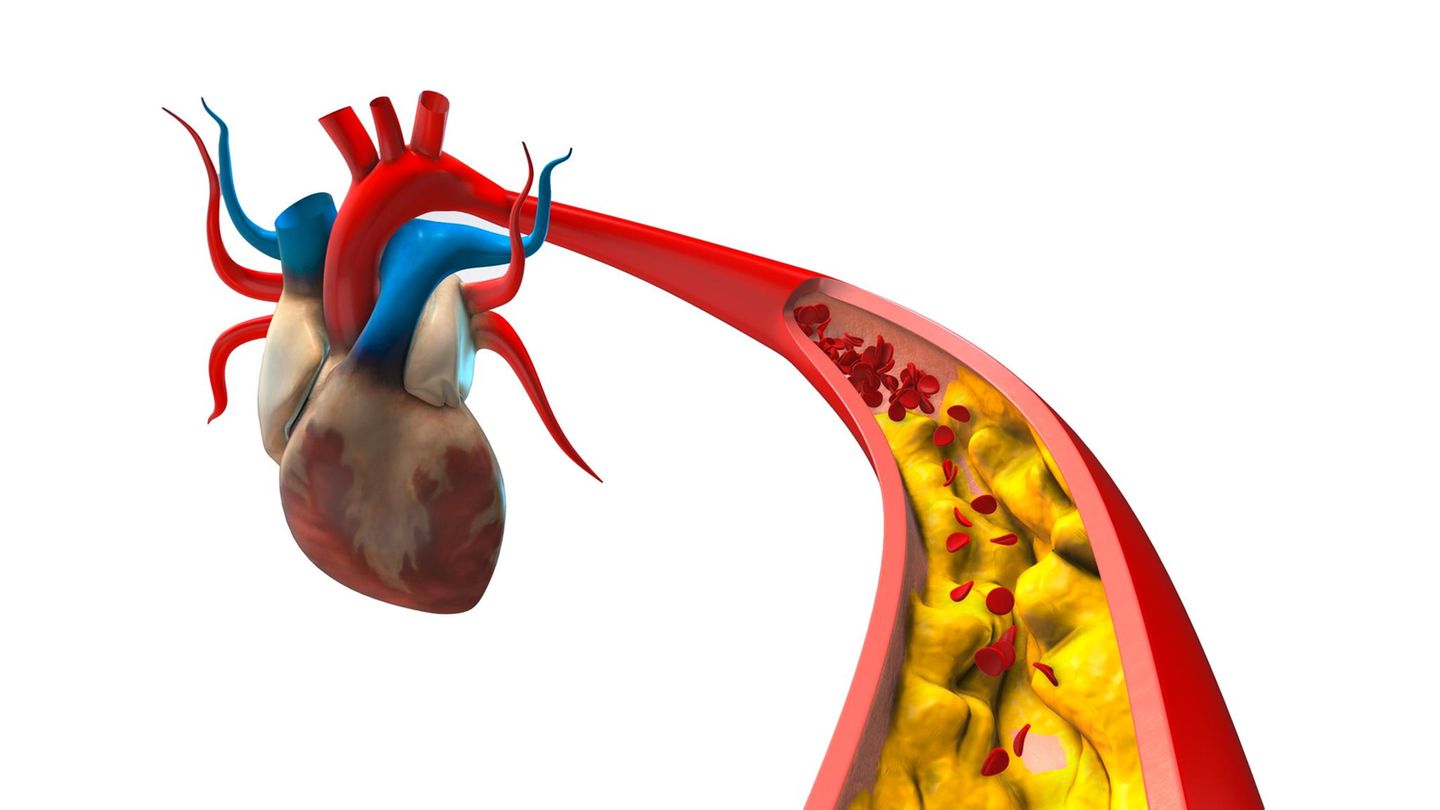 Illustration einer Aorta mit Cholesterin-Ablagerungen