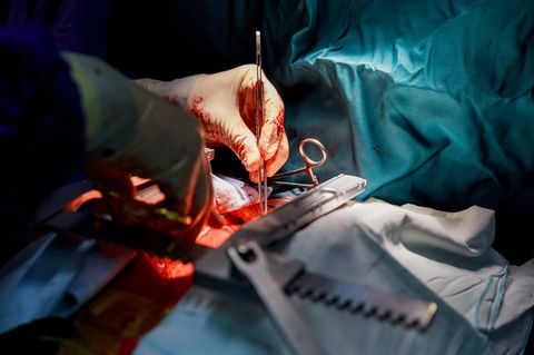 Aorta-Operation (Symbolbild): Eine Chirurgenhand arbeitet im OP mit einer Pinzette am geöffneten Brustkorb